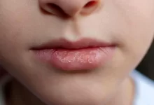 eczema-on-lips-can-be-painful-and-distressing